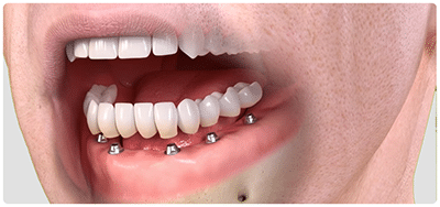 all on 4 teeth implant