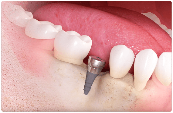 Dental implants treatments