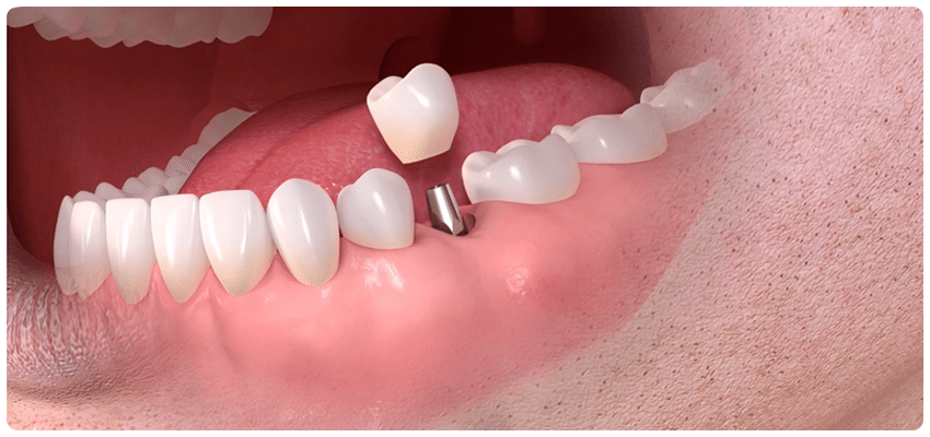 Teeth implants Turkey