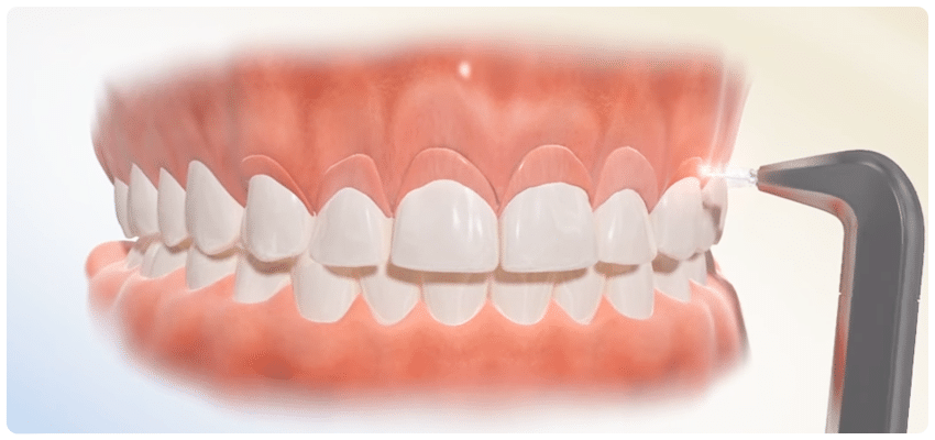 gummy smile treatments