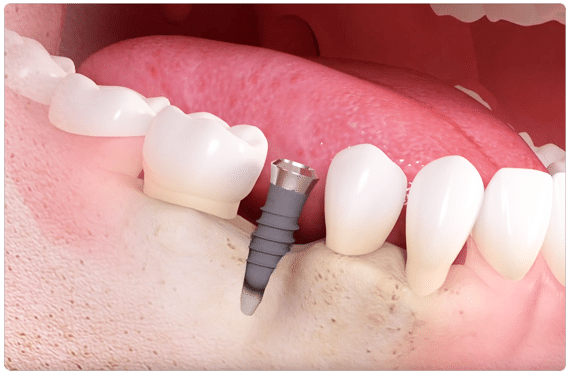 Teeth implant