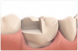 inlay onlay dental restoration