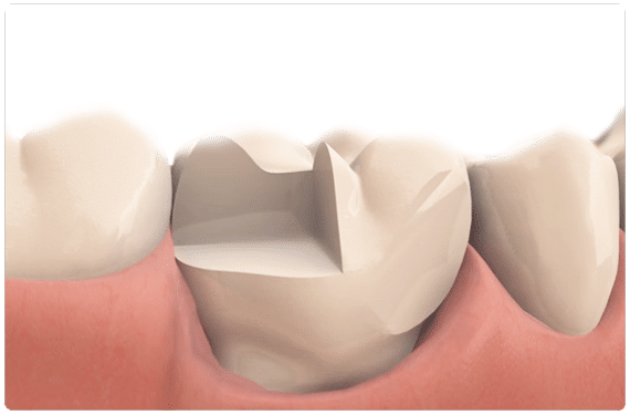inlay onlay dental restoration