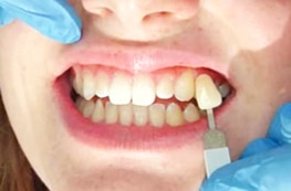 New Teeth Turkey | Dentist in Turkey