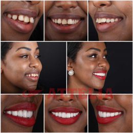 Hollywood smile design in Turkey