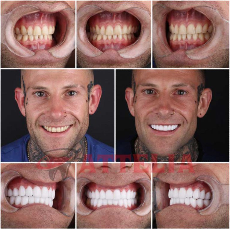 Smile Makeover in Turkey, Hollywood Smile Design New Teeth Turkey