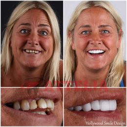 Smile makeover in Turkey