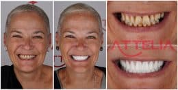 all-on-6-dental-treatment-turkey