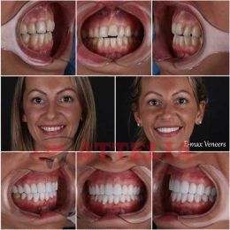 E-max veneers Turkey