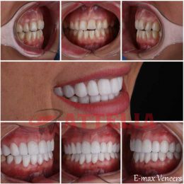 Veneers in Turkey prices