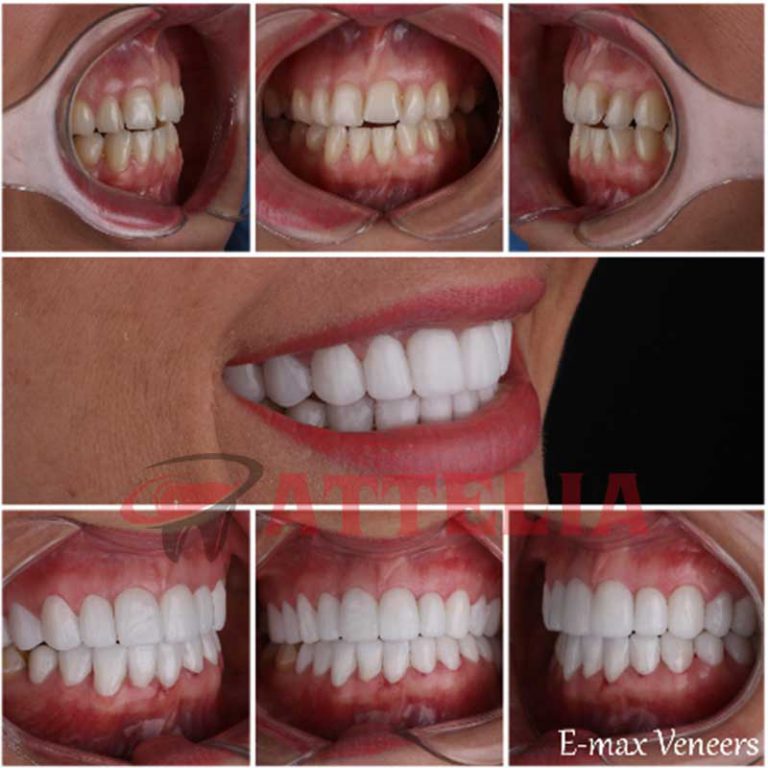 Veneers in Turkey Porcelain, EMax, Laminate, Zirconium New Teeth