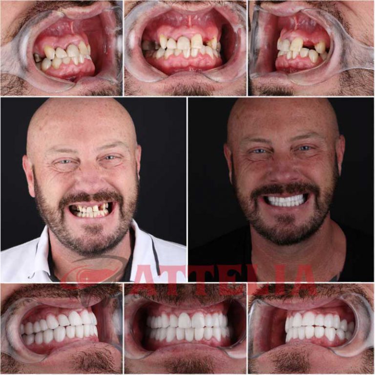 Veneers in Turkey Porcelain, EMax, Laminate, Zirconium New Teeth Turkey Dentist In Turkey