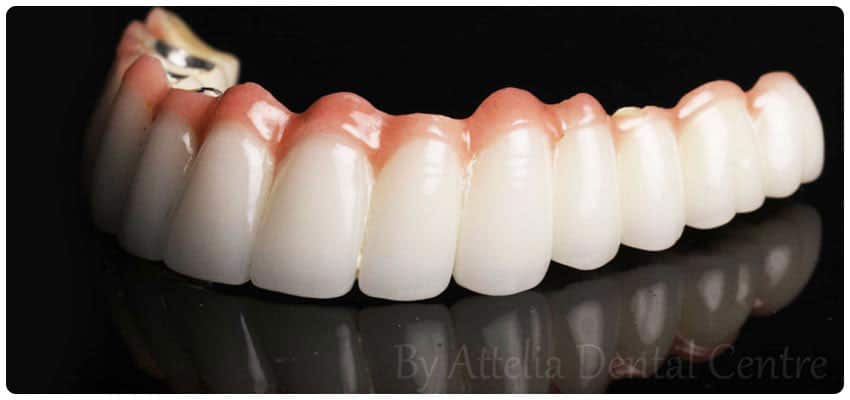 Metal supported porcelain crowns Turkey