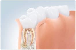 dental root treatment