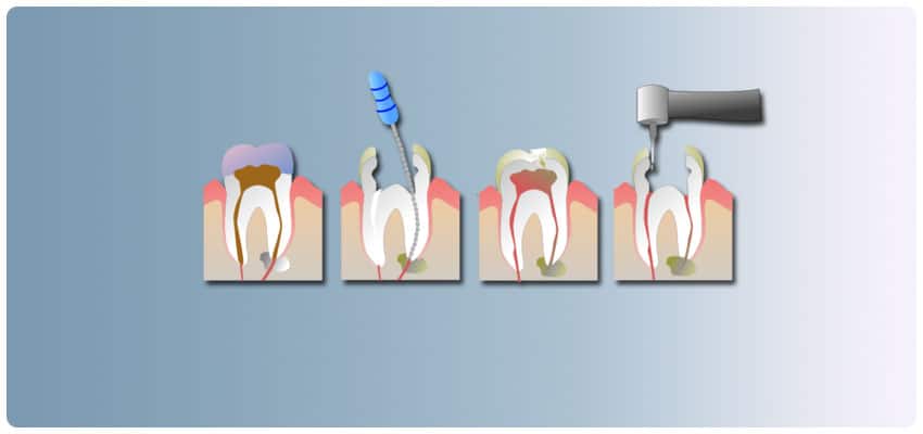 root canal treatments in Turkey