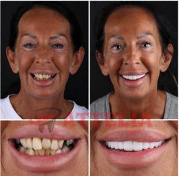 Dental veneers in Turkey