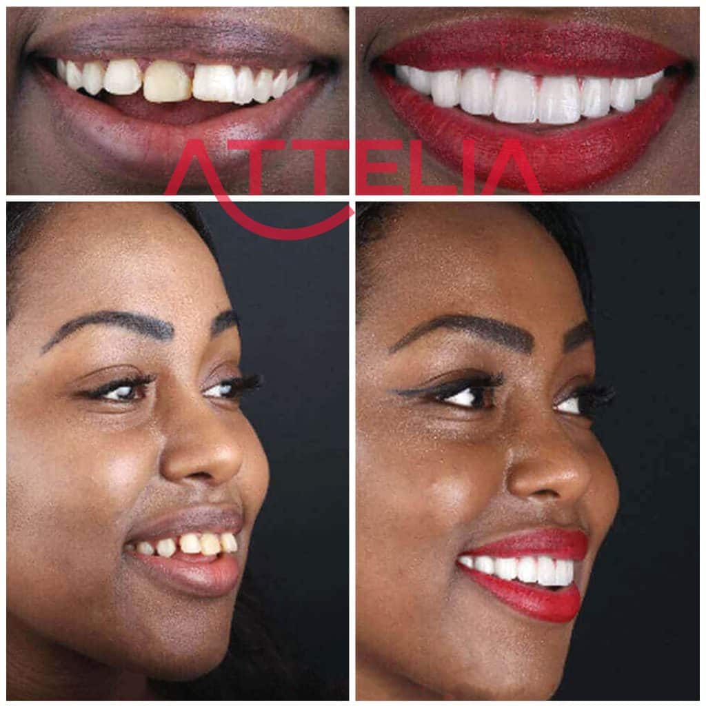 Veneers in Turkey Porcelain, EMax, Laminate, Zirconium New Teeth