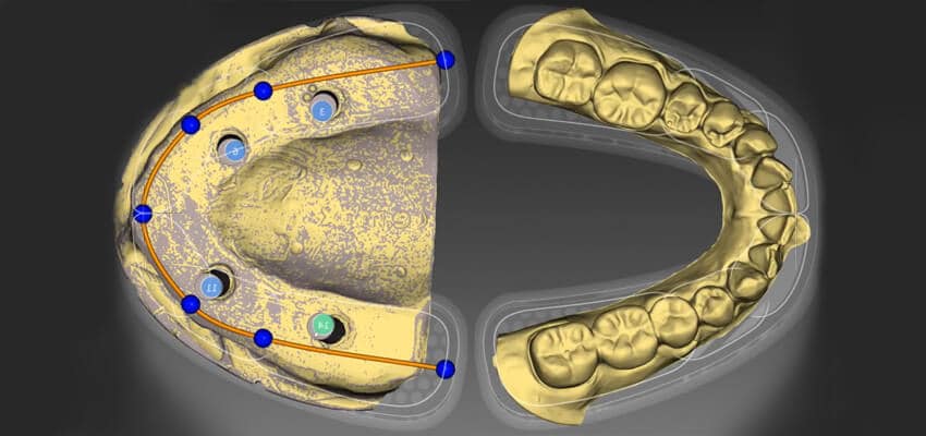 all-on-4-dental-implants-Turkey cost